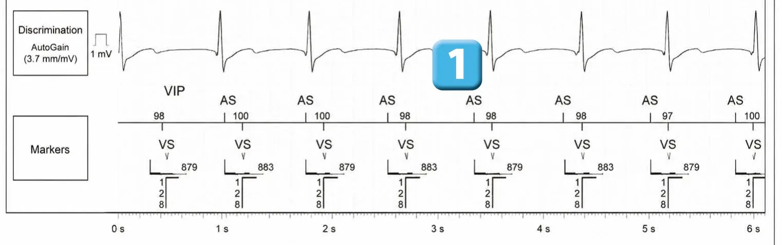 Abbott ICD electrogram, segment 1 of 4 — Dual chamber and V< A branch discrimination