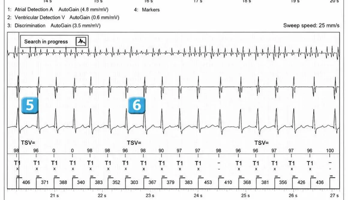 Abbott ICD electrogram, segment 2 of 3 — Dual chamber and V< A branch discrimination