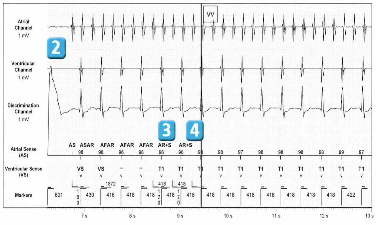 Abbott ICD electrogram, segment 2 of 4 — Dual chamber and V< A branch discrimination