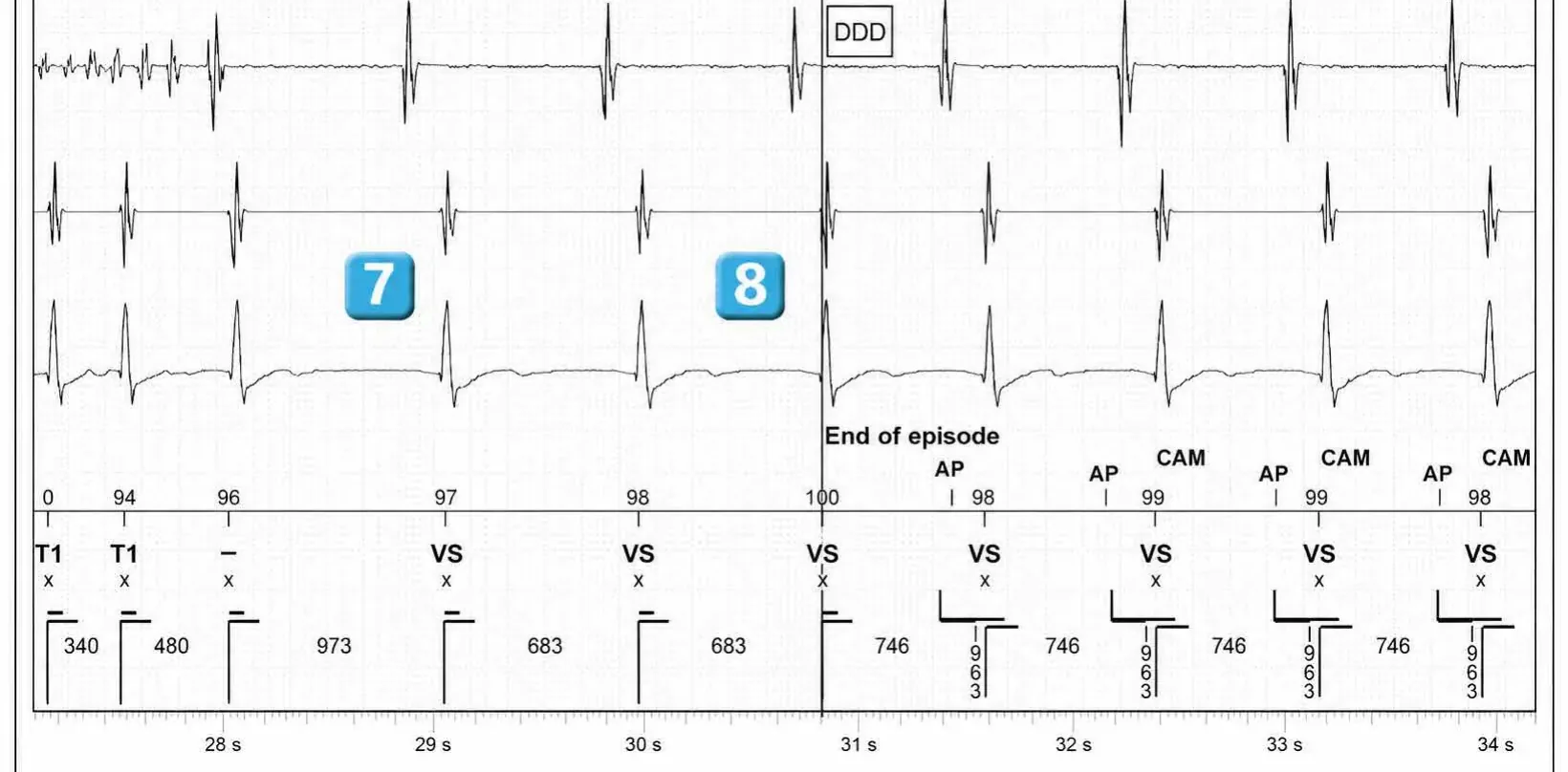 Abbott ICD electrogram, segment 3 of 3 — Dual chamber and V< A branch discrimination