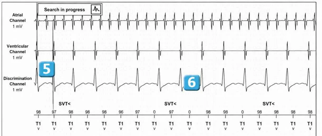 Abbott ICD electrogram, segment 3 of 4 — Dual chamber and V< A branch discrimination