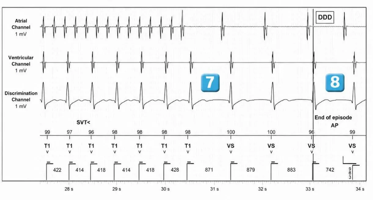 Abbott ICD electrogram, segment 4 of 4 — Dual chamber and V< A branch discrimination