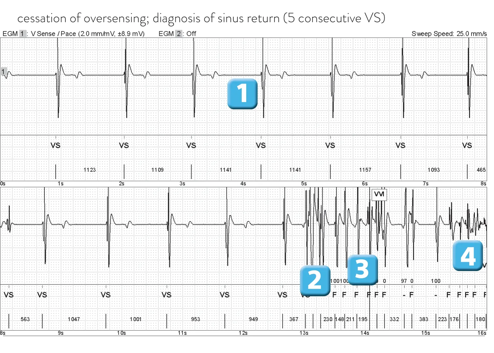 Abbott ICD electrogram, segment 1 of 2 — Lead breakage on an older model