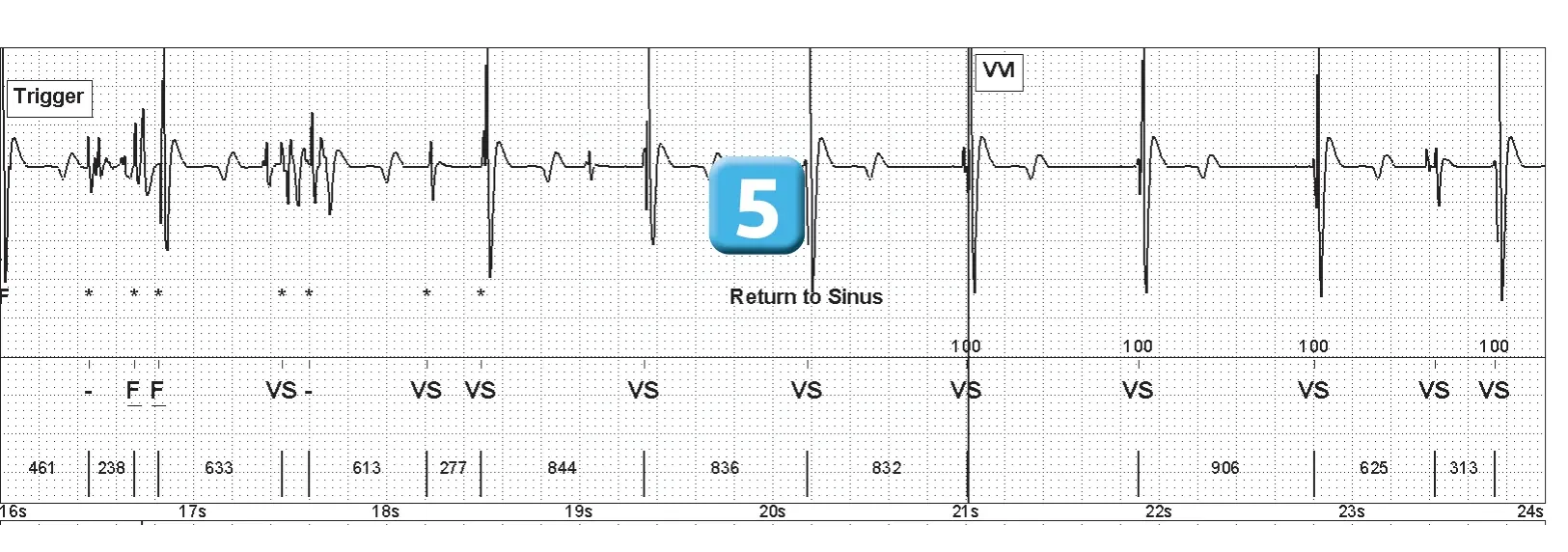 Abbott ICD electrogram, segment 2 of 2 — Lead breakage on an older model