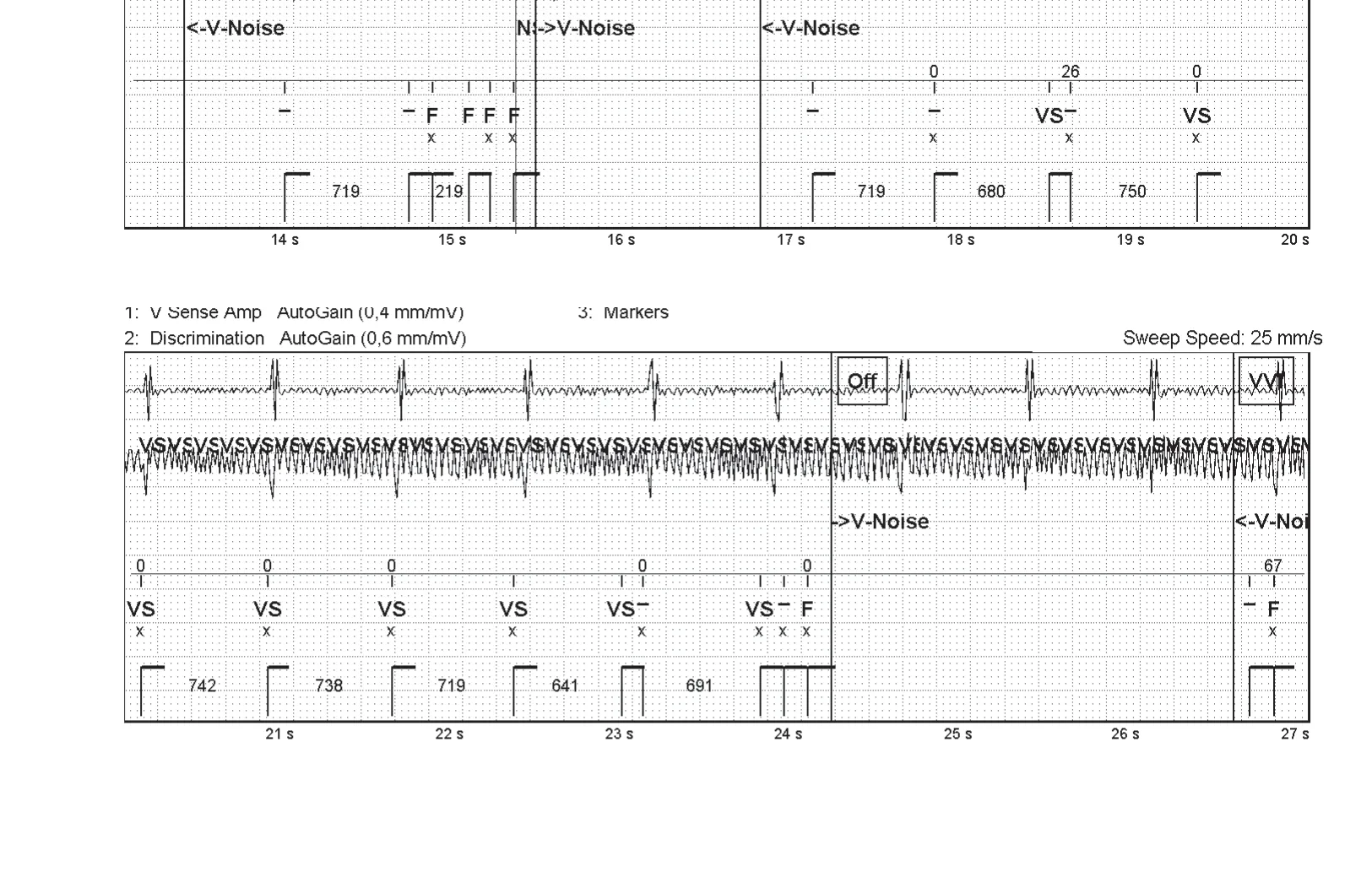 Oversensing of a 50 Hz signal