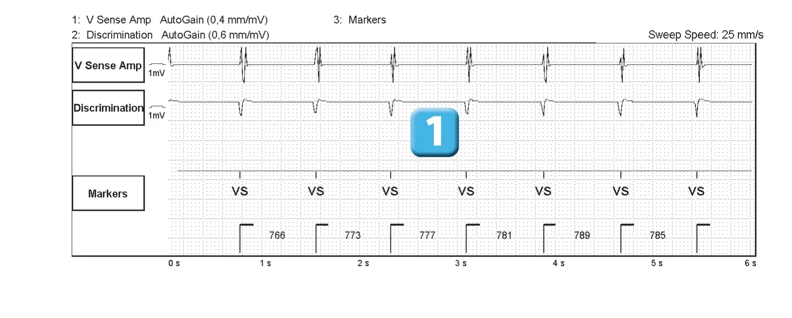 Abbott ICD electrogram, segment 1 of 2 — Oversensing of a 50 Hz signal