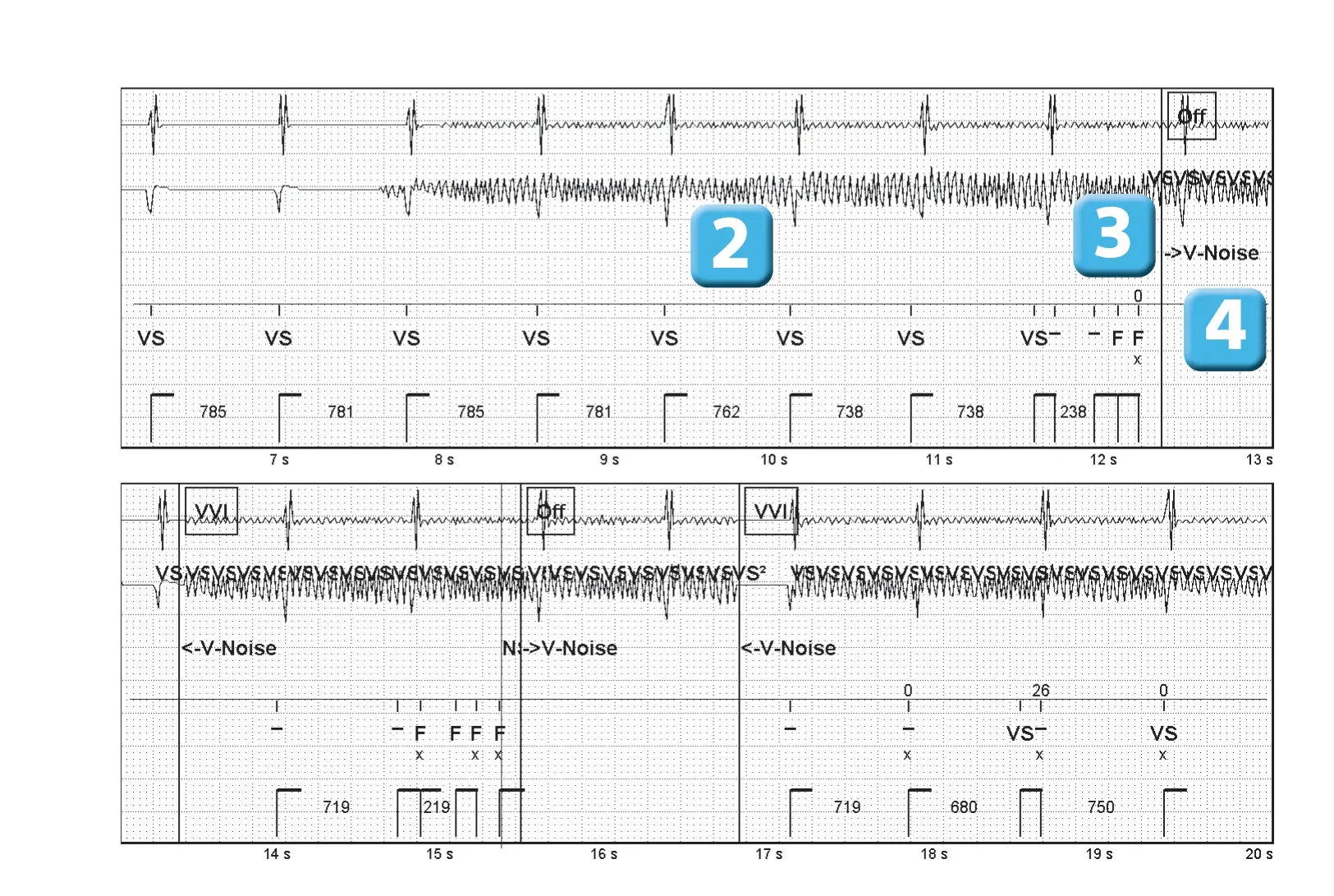 Abbott ICD electrogram, segment 2 of 2 — Oversensing of a 50 Hz signal