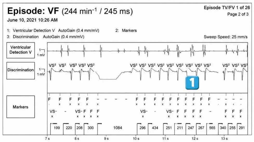 Abbott ICD electrogram, segment 1 of 4 — Surgery and use of an electric scalpel