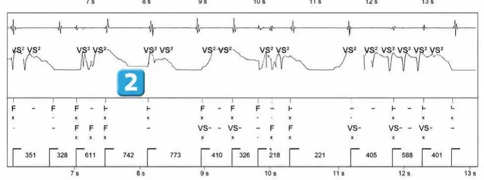 Abbott ICD electrogram, segment 2 of 4 — Surgery and use of an electric scalpel