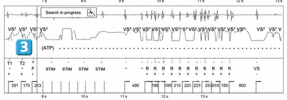 Abbott ICD electrogram, segment 3 of 4 — Surgery and use of an electric scalpel