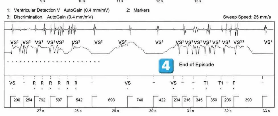 Abbott ICD electrogram, segment 4 of 4 — Surgery and use of an electric scalpel