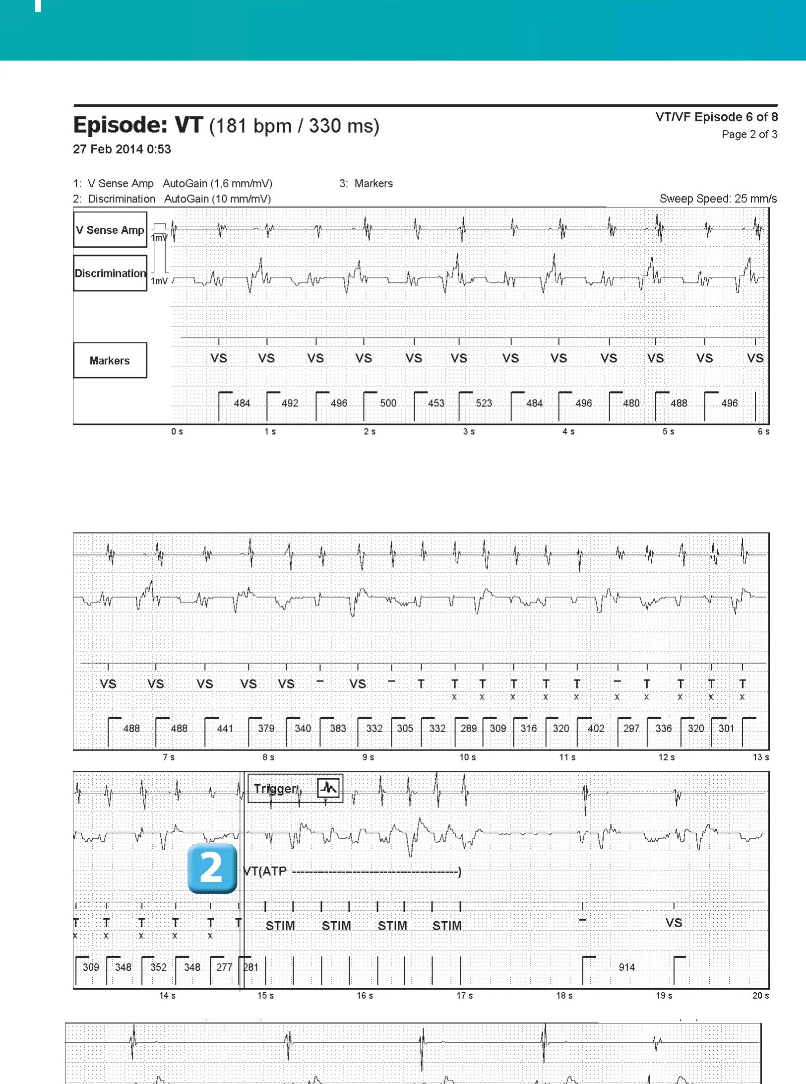 SecureSense™ algorithm and undersensing on the discrimination channel