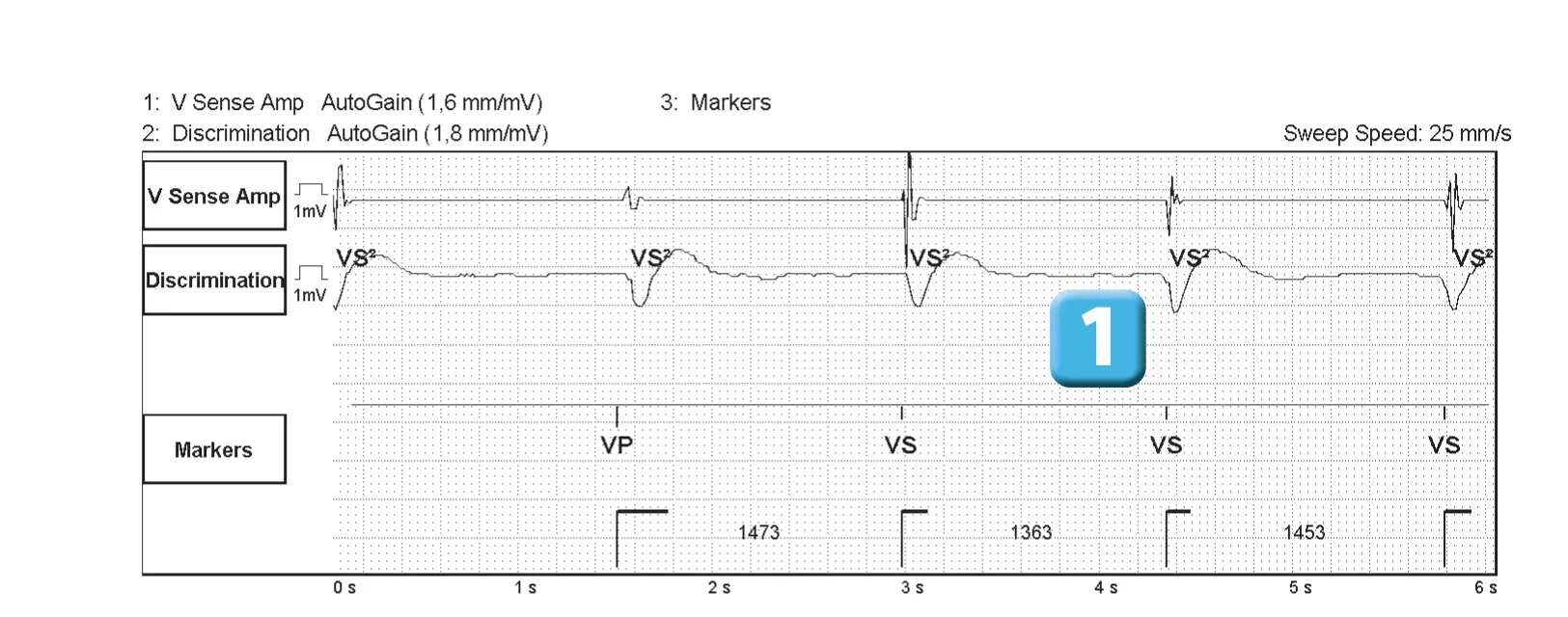 Abbott ICD electrogram, segment 1 of 2 — SecureSense™ algorithm and undersensing on the discrimination channel