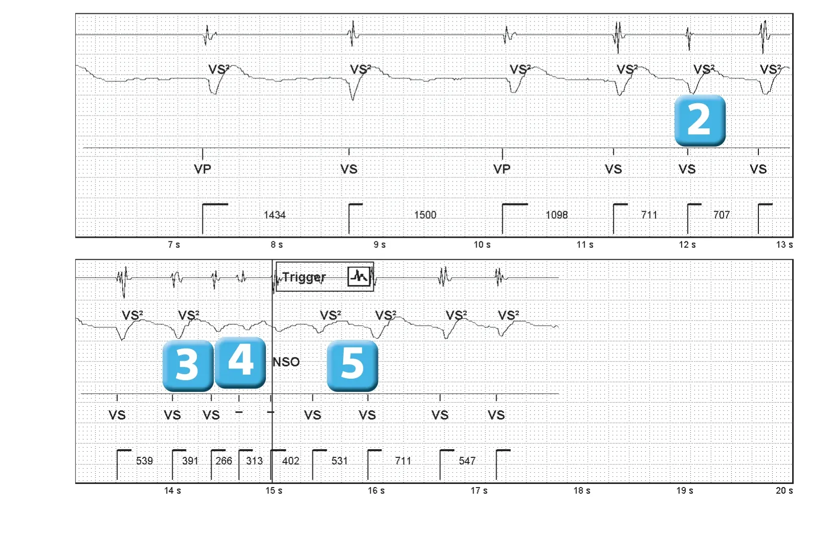 Abbott ICD electrogram, segment 2 of 2 — SecureSense™ algorithm and undersensing on the discrimination channel