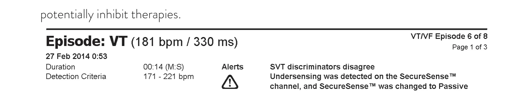 Abbott ICD electrogram, segment 1 of 2 — SecureSense™ algorithm and undersensing on the discrimination channel