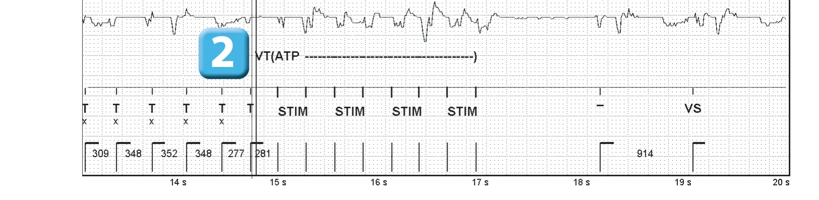 Abbott ICD electrogram, segment 2 of 2 — SecureSense™ algorithm and undersensing on the discrimination channel
