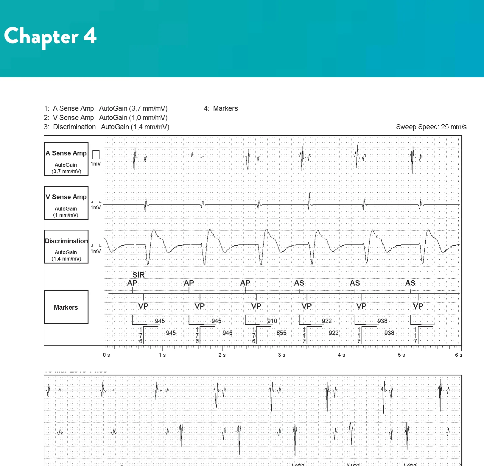 SecureSense™ algorithm and loss of right ventricular capture