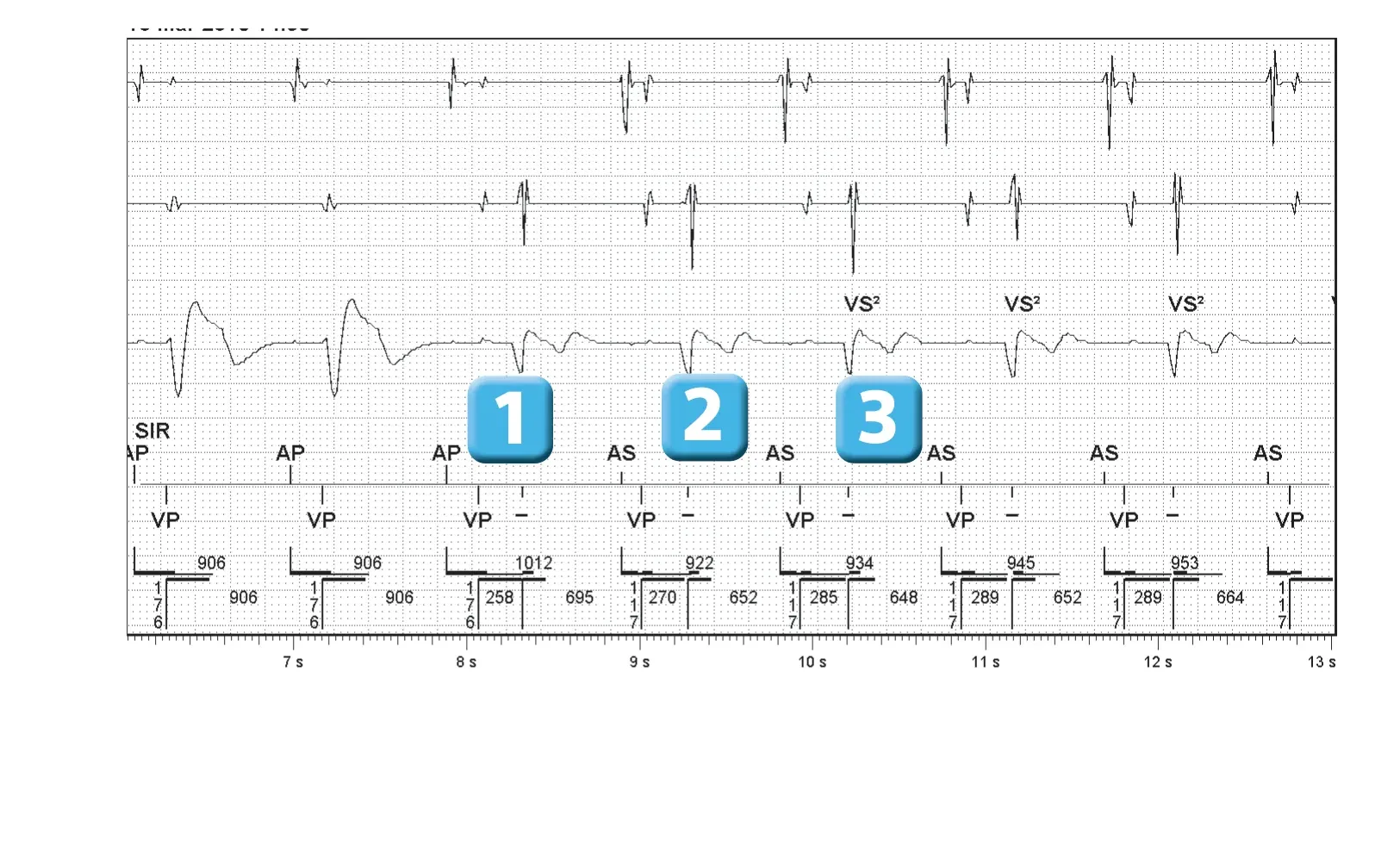 Abbott ICD electrogram, segment 1 of 2 — SecureSense™ algorithm and loss of right ventricular capture