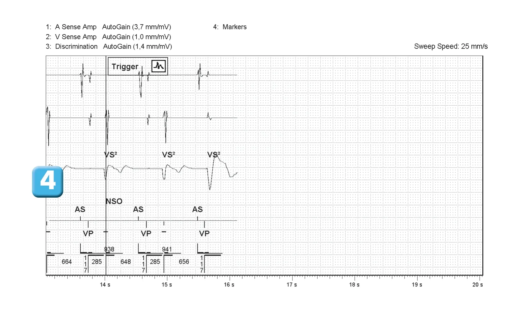 Abbott ICD electrogram, segment 2 of 2 — SecureSense™ algorithm and loss of right ventricular capture