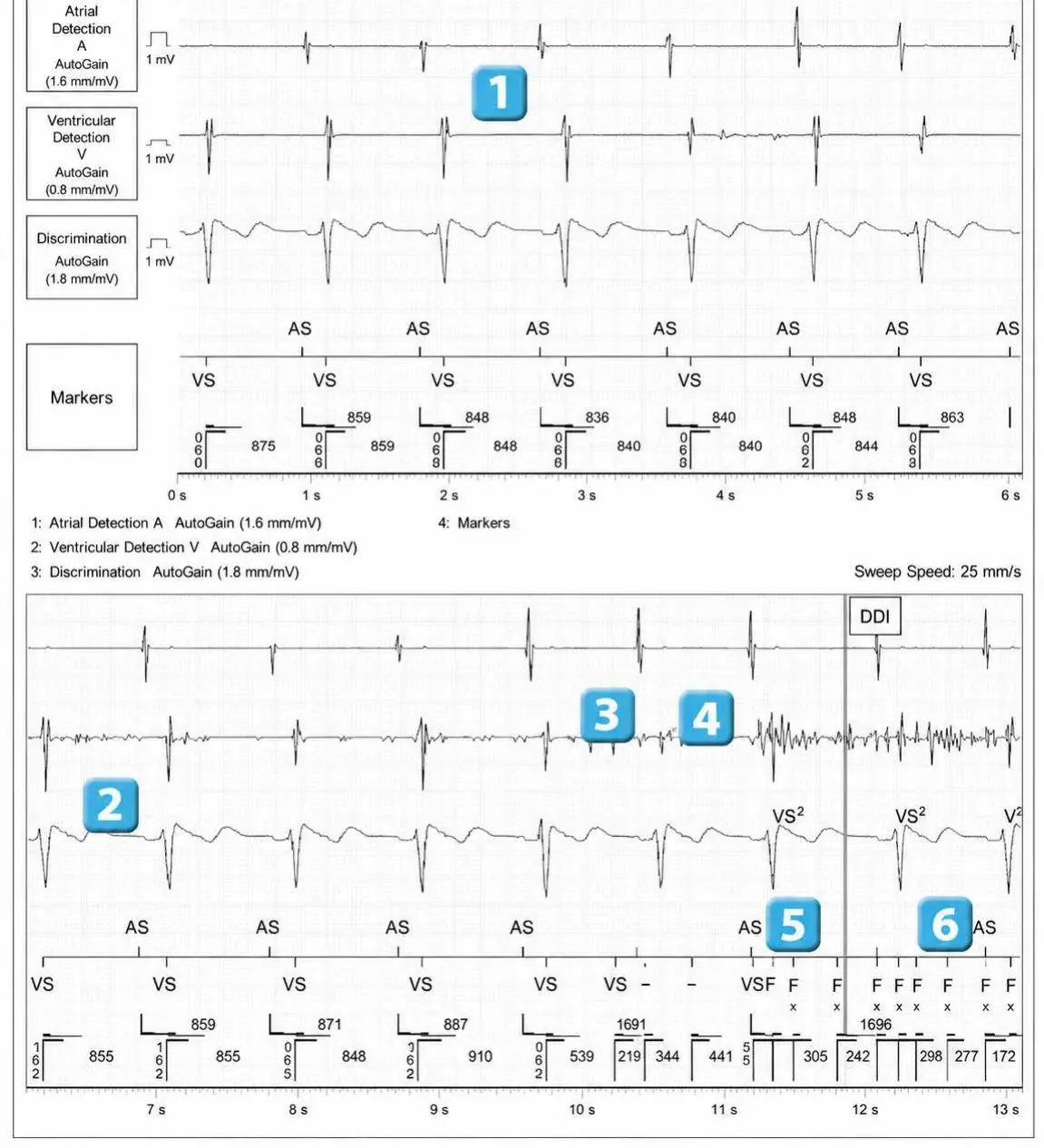 Abbott ICD electrogram, segment 1 of 2 — Recent device, lead malfunction, and SecureSense™ algorithm