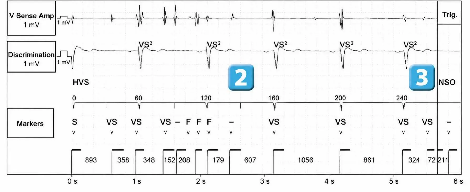 Abbott ICD electrogram, segment 1 of 2 — Recent device, lead malfunction, and SecureSense™ algorithm