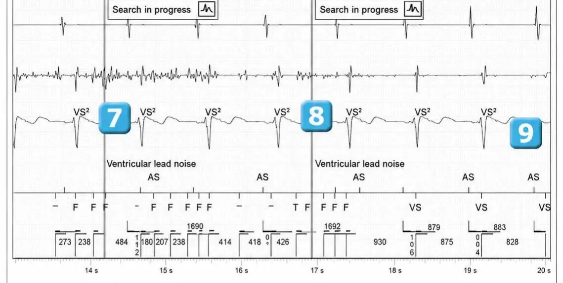 Abbott ICD electrogram, segment 2 of 2 — Recent device, lead malfunction, and SecureSense™ algorithm