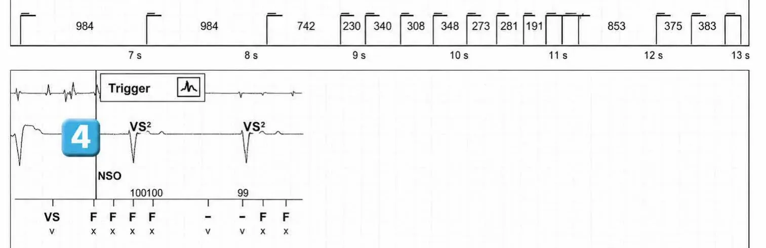 Abbott ICD electrogram, segment 2 of 2 — Recent device, lead malfunction, and SecureSense™ algorithm