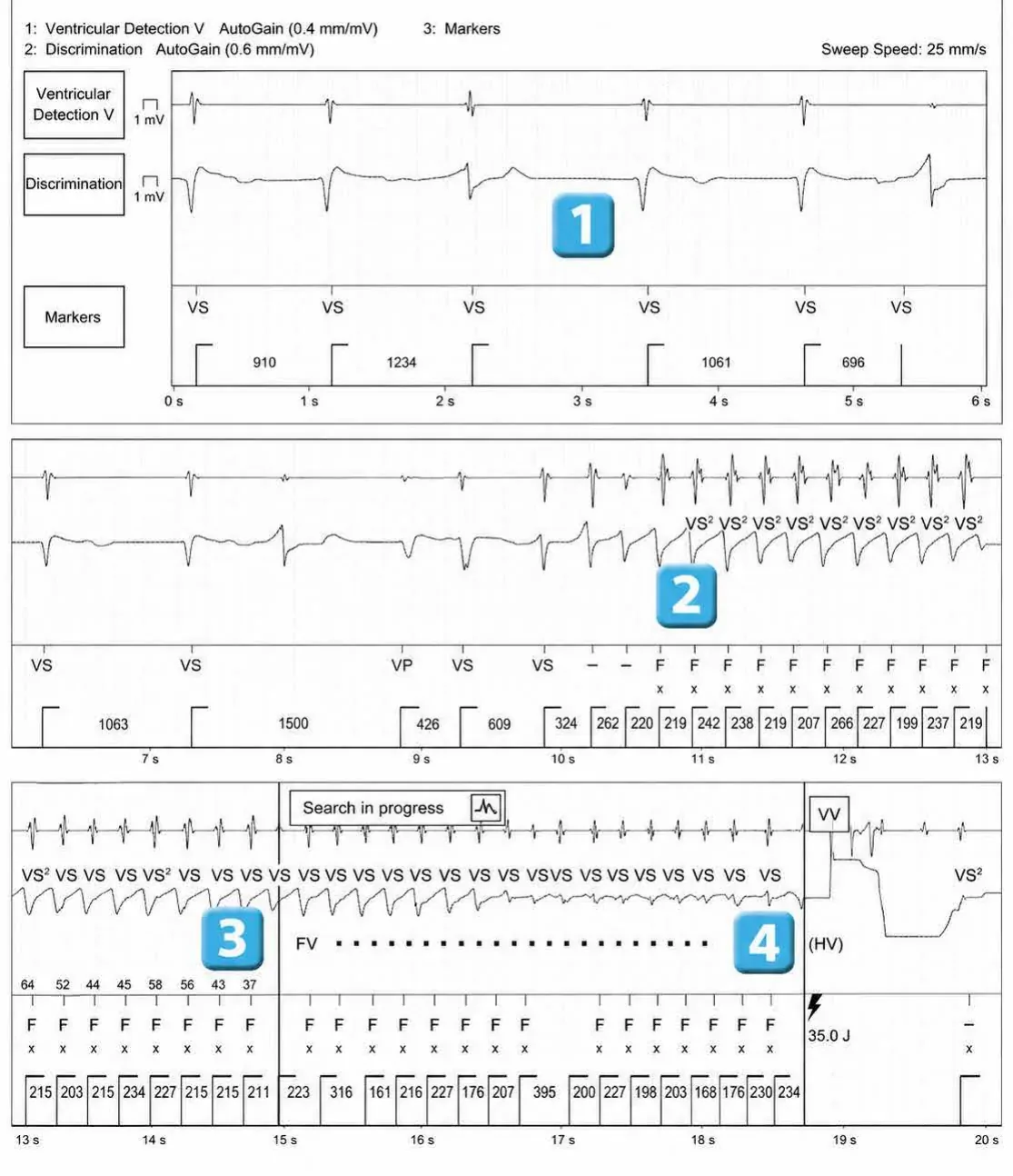 Abbott ICD electrogram, segment 1 of 2 — Lead malfunction revealed by an electric shock