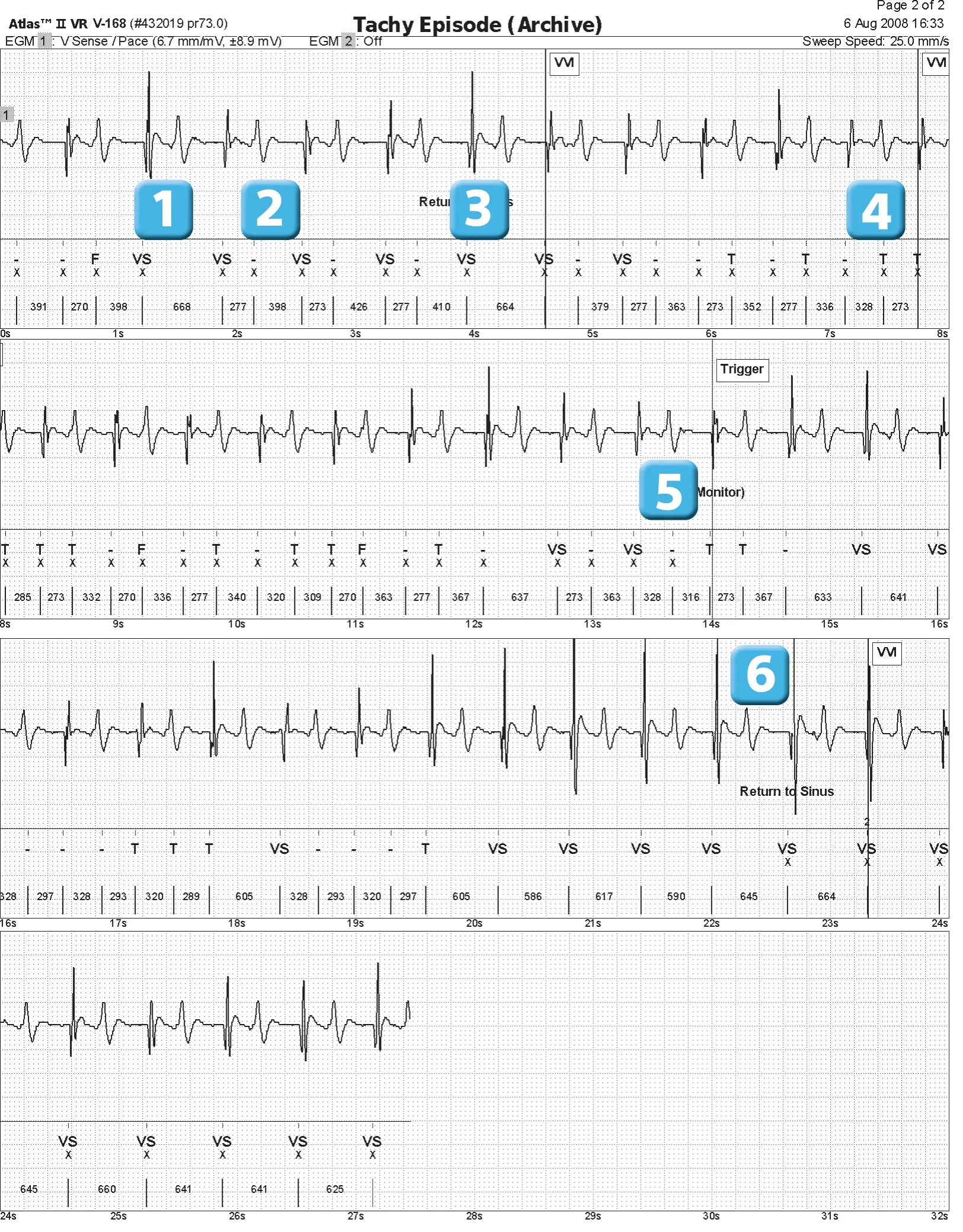 Abbott ICD electrogram, segment 1 of 1 — Oversensing of the T wave on an older model