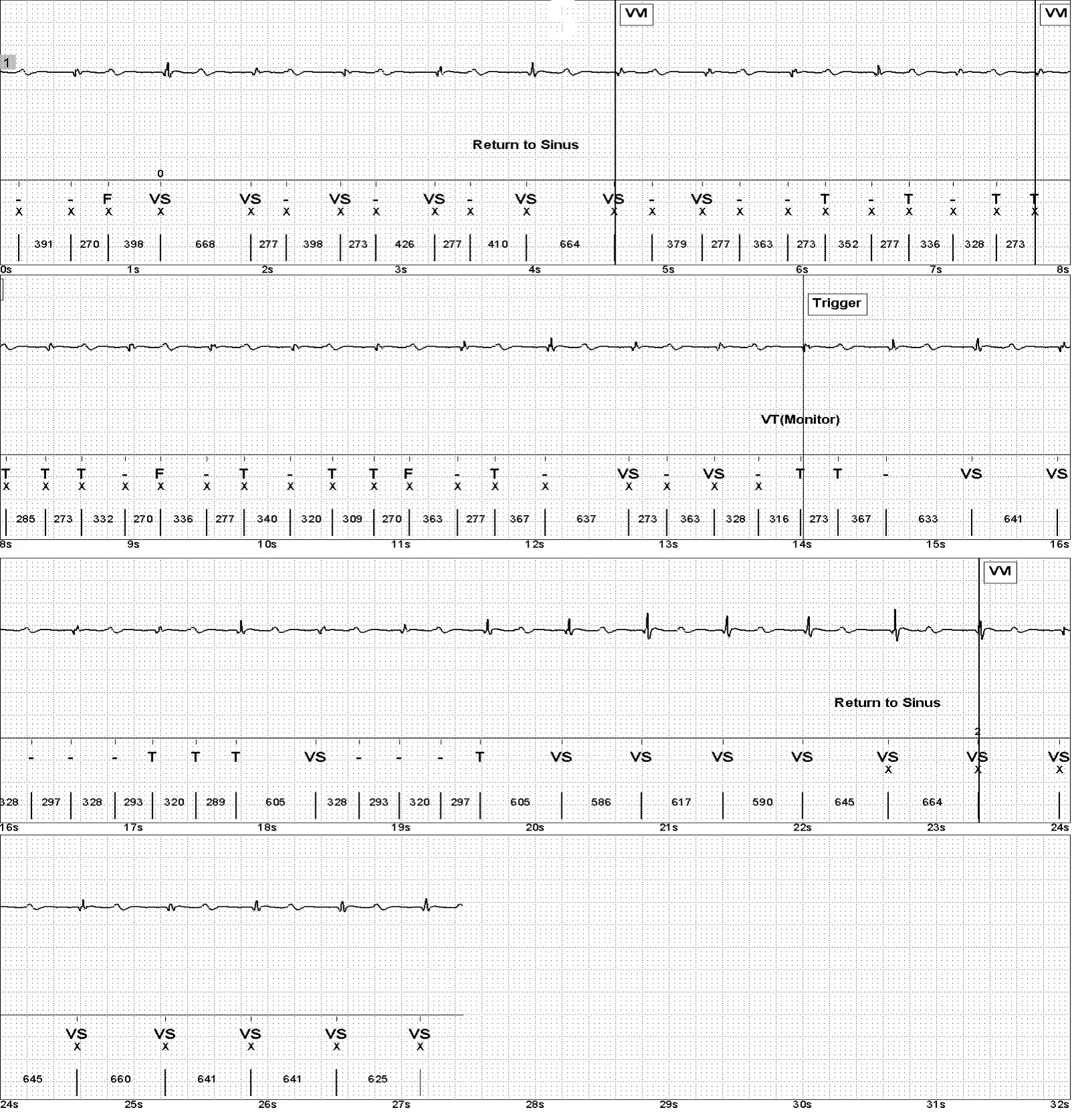 Abbott ICD electrogram, segment 1 of 1 — Oversensing of the T wave on an older model