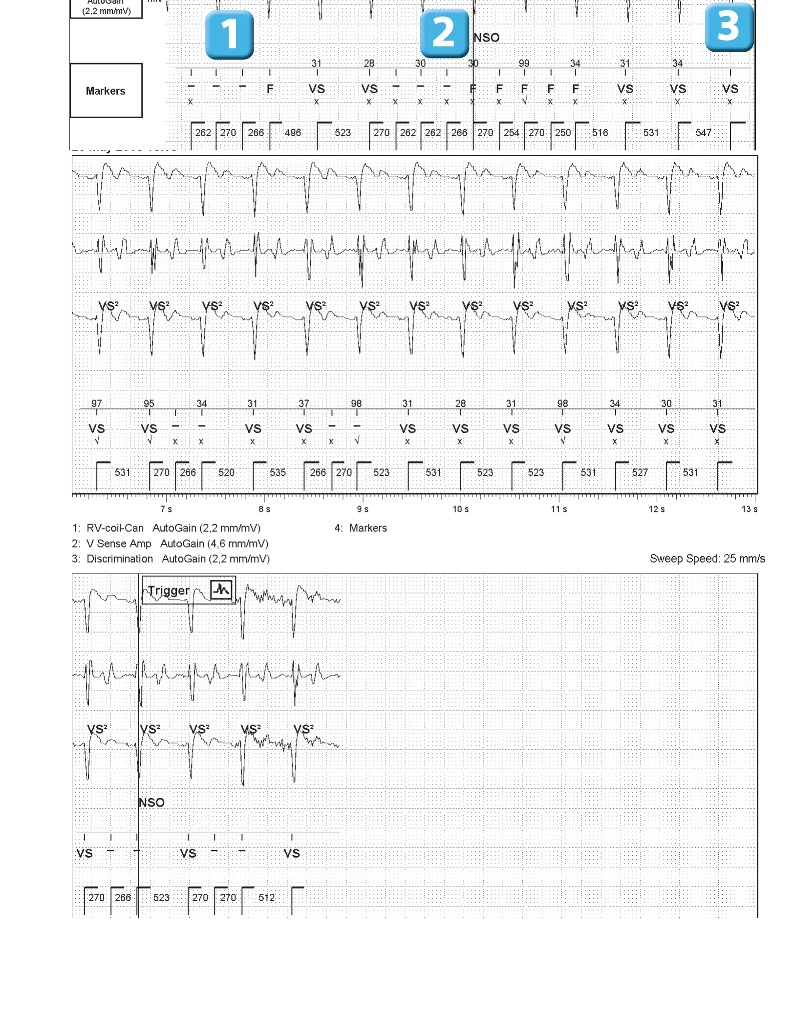 New device, T wave oversensing, and SecureSense™ algorithm