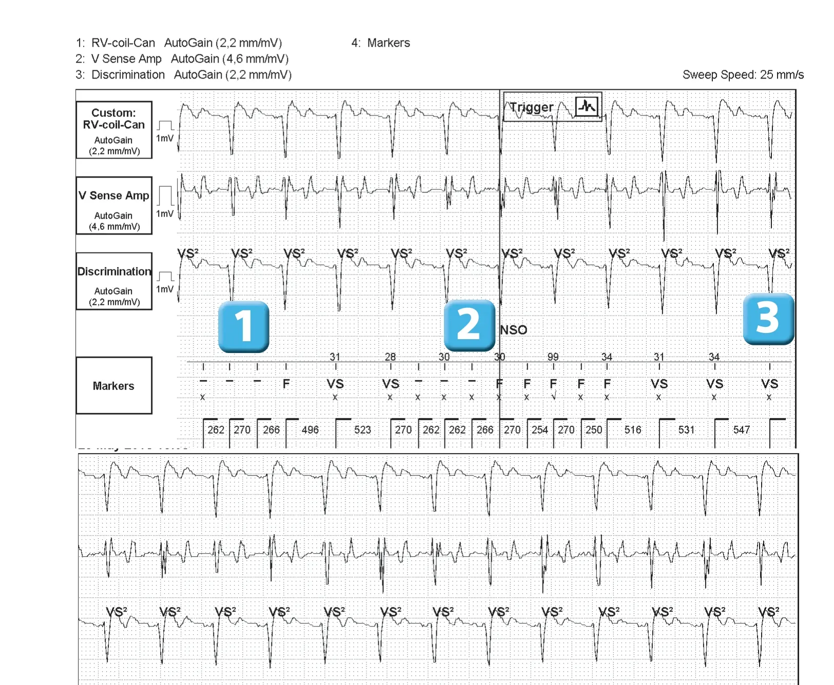 Abbott ICD electrogram, segment 1 of 1 — New device, T wave oversensing, and SecureSense™ algorithm