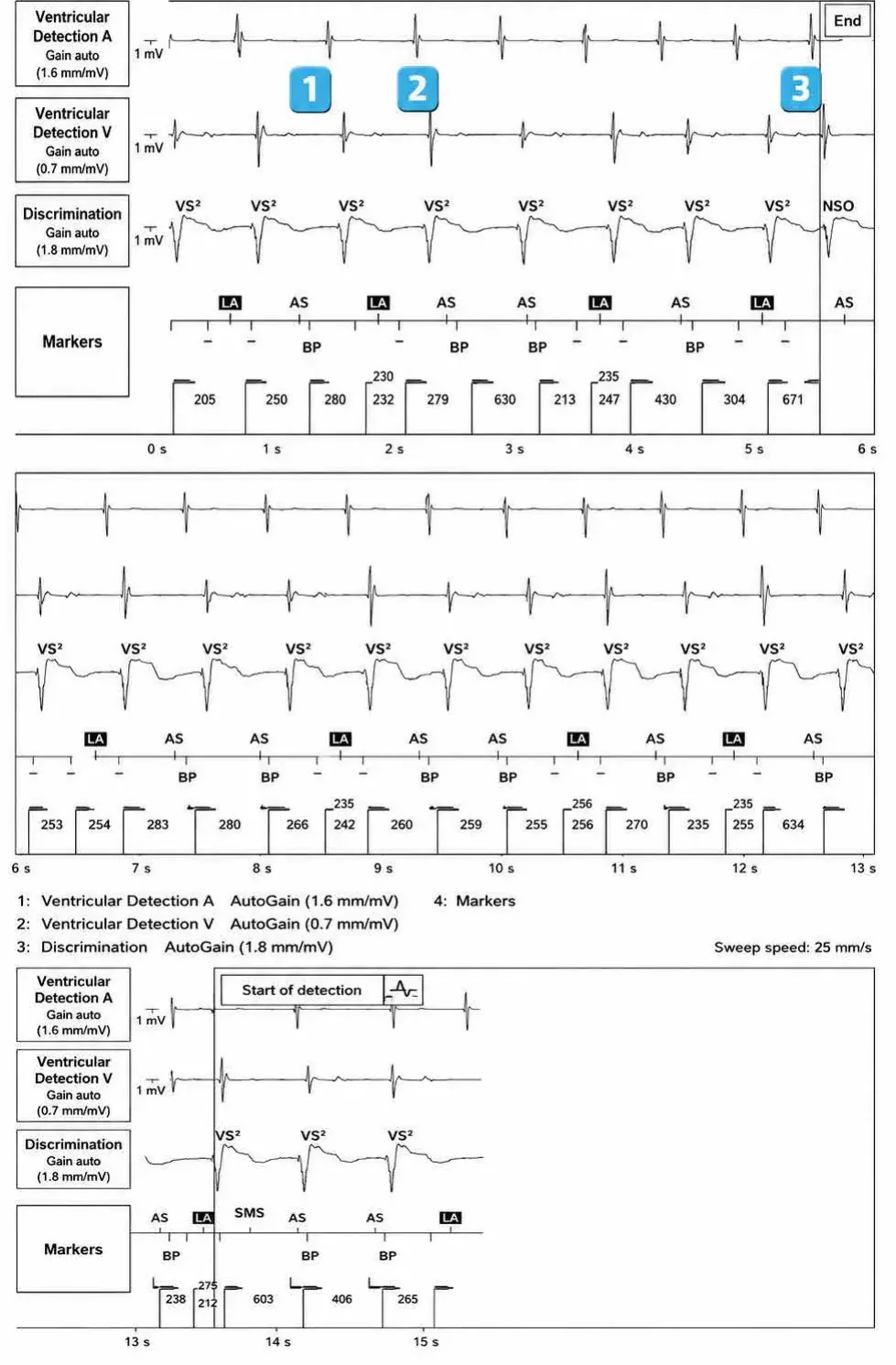 Abbott ICD electrogram, segment 1 of 1 — New device, post-stimulation T wave oversensing, and SecureSense™ algorithm
