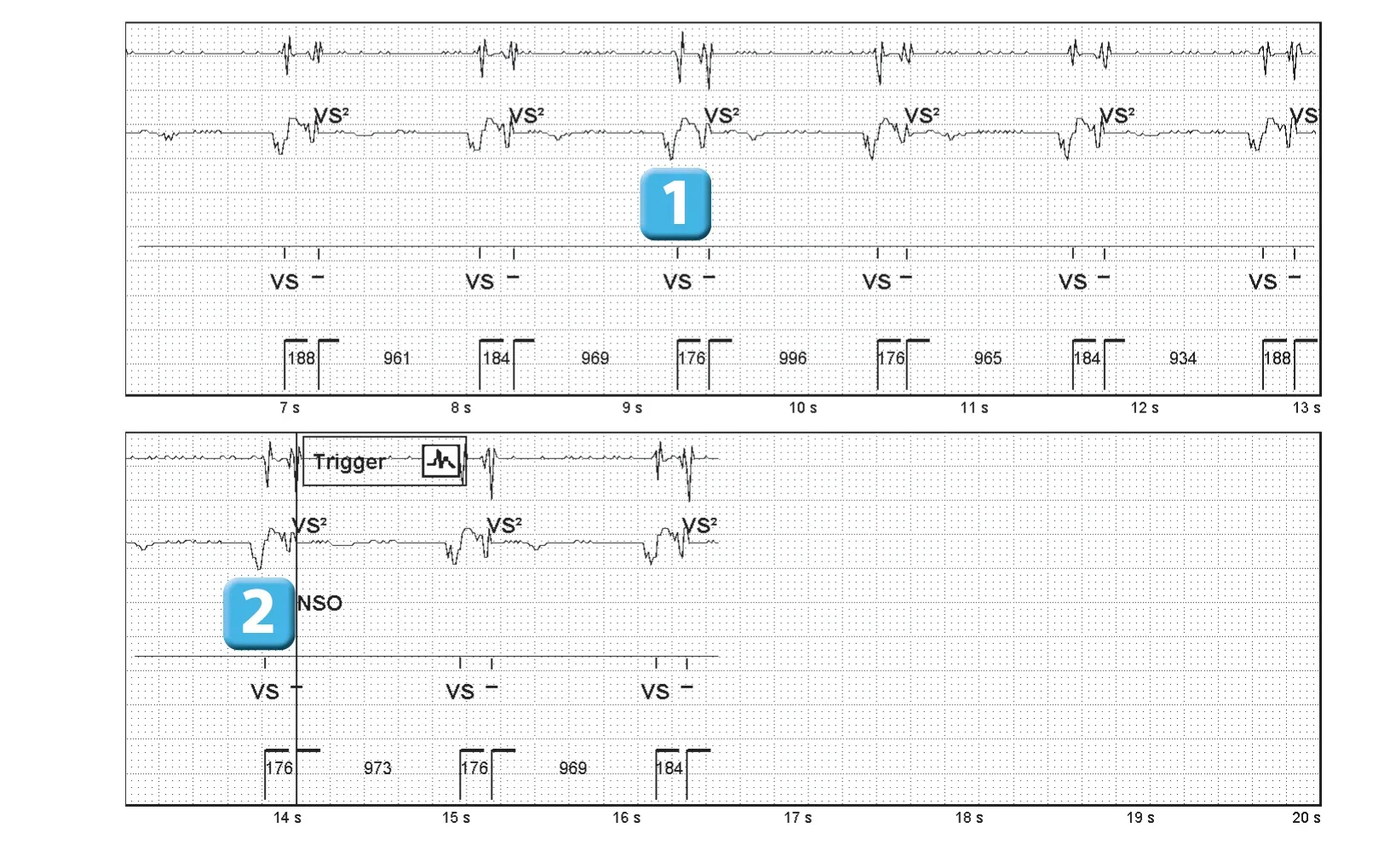 Abbott ICD electrogram, segment 1 of 1 — Recent device, P wave oversensing, and SecureSense™ algorithm