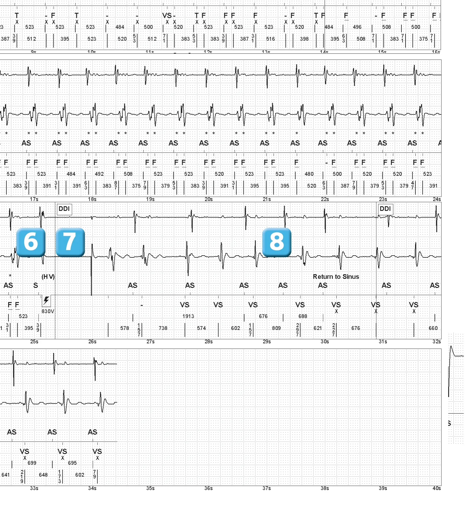 Abbott ICD electrogram, segment 2 of 2 — Double counting of the R wave on an older model