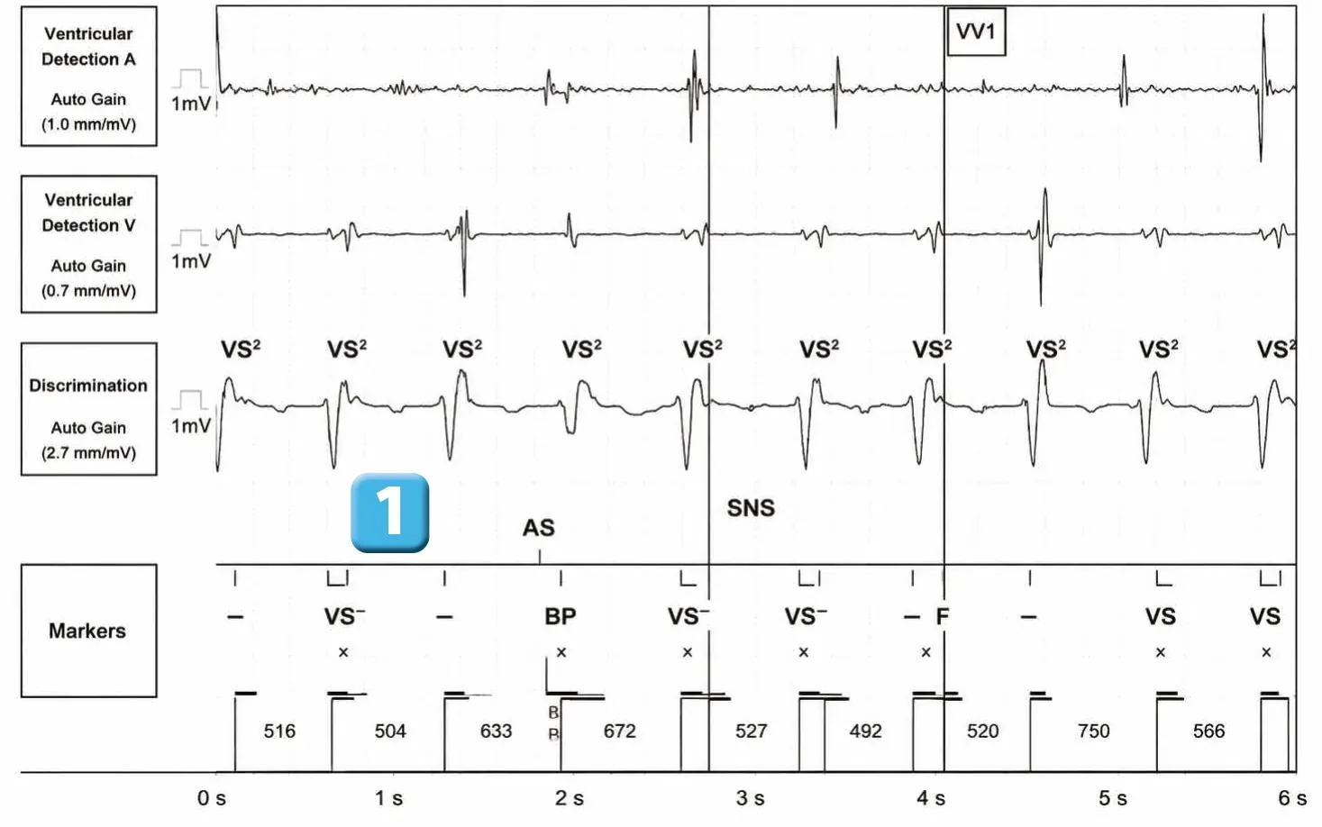 Abbott ICD electrogram, segment 1 of 2 — New device, dual R-wave counting and SecureSense™ algorithm