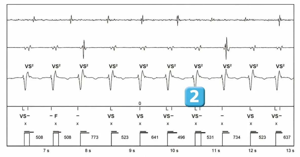 Abbott ICD electrogram, segment 2 of 2 — New device, dual R-wave counting and SecureSense™ algorithm