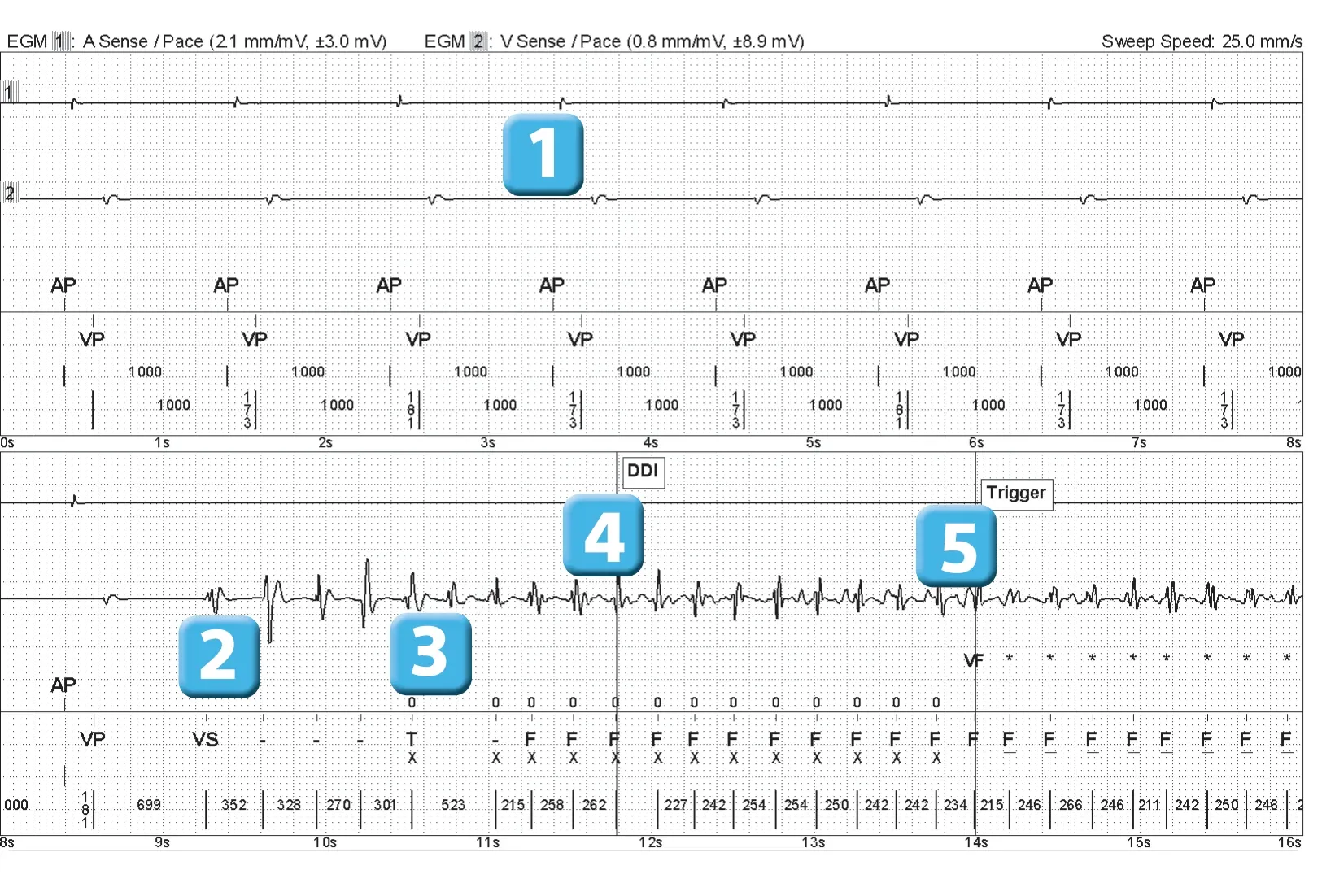 Abbott ICD electrogram, segment 1 of 4 — Episode of ventricular fibrillation and high defibrillation threshold