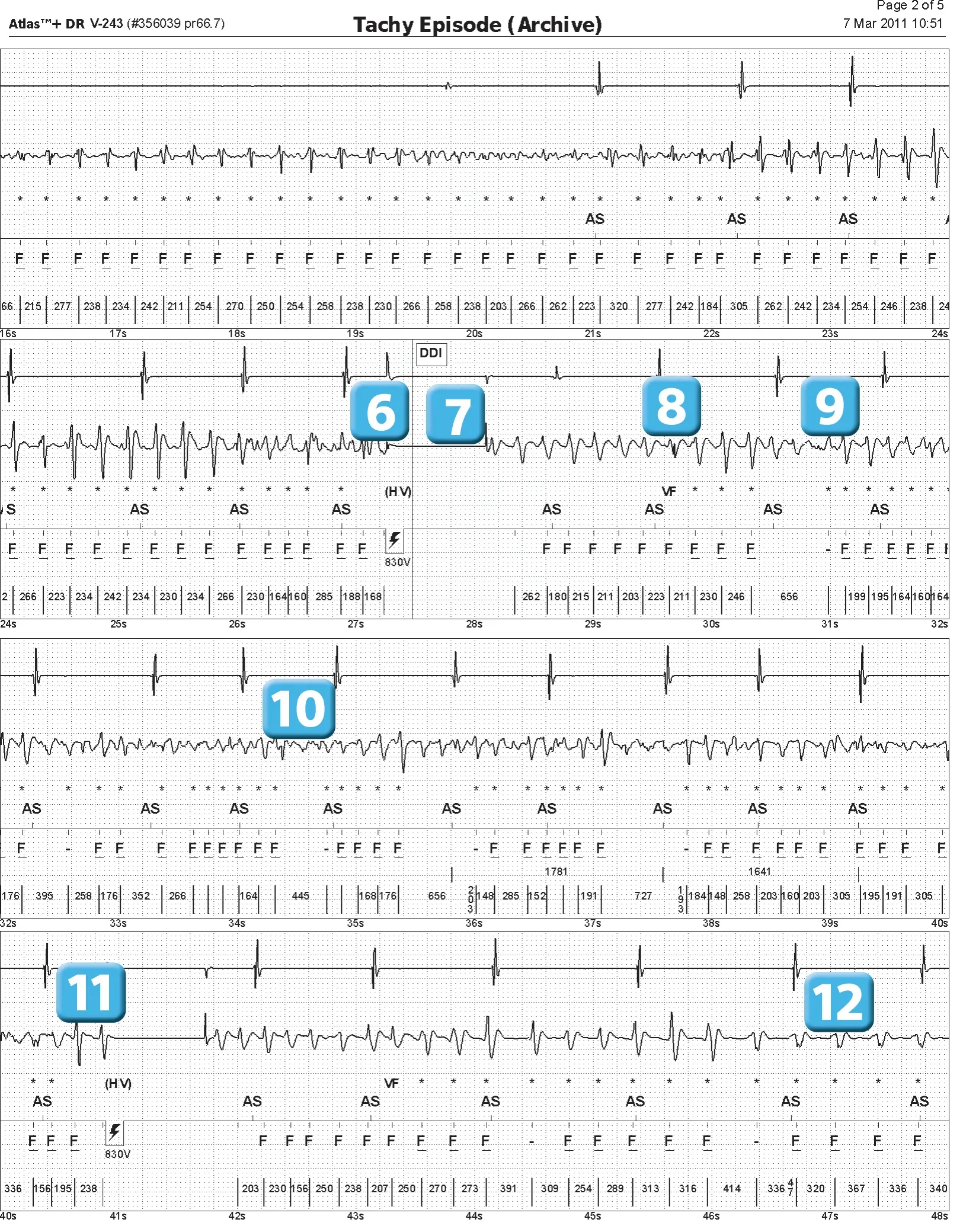Abbott ICD electrogram, segment 2 of 4 — Episode of ventricular fibrillation and high defibrillation threshold