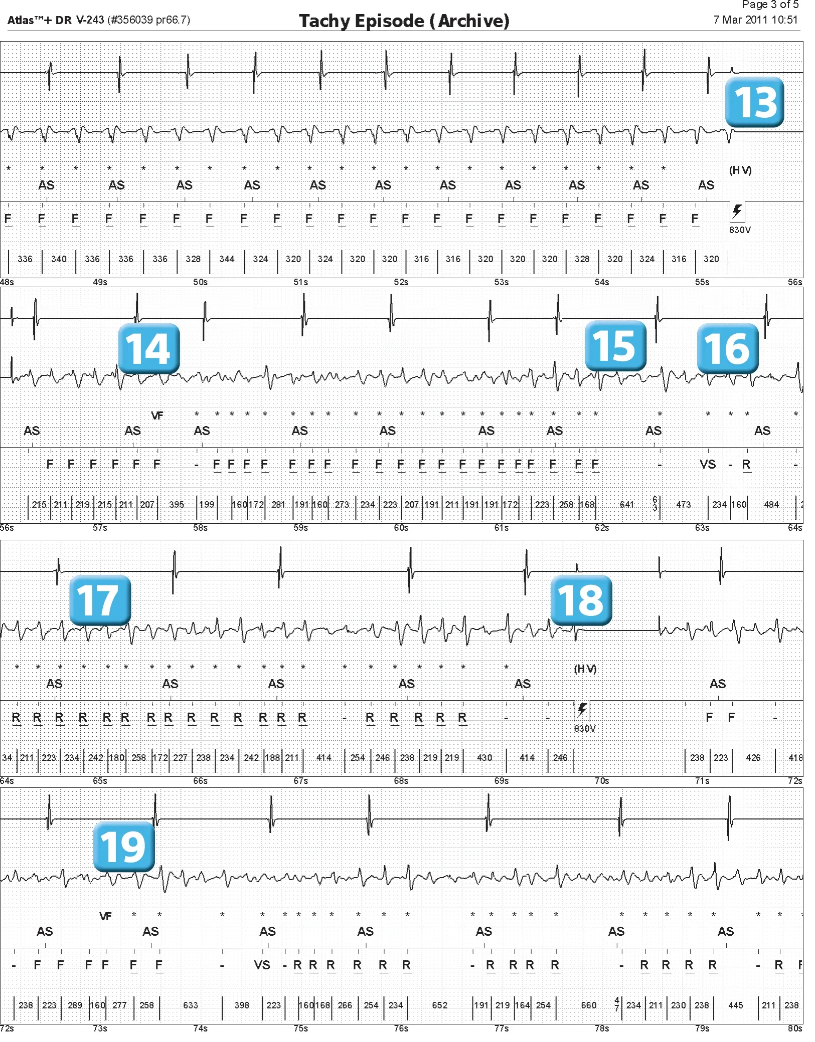 Abbott ICD electrogram, segment 3 of 4 — Episode of ventricular fibrillation and high defibrillation threshold