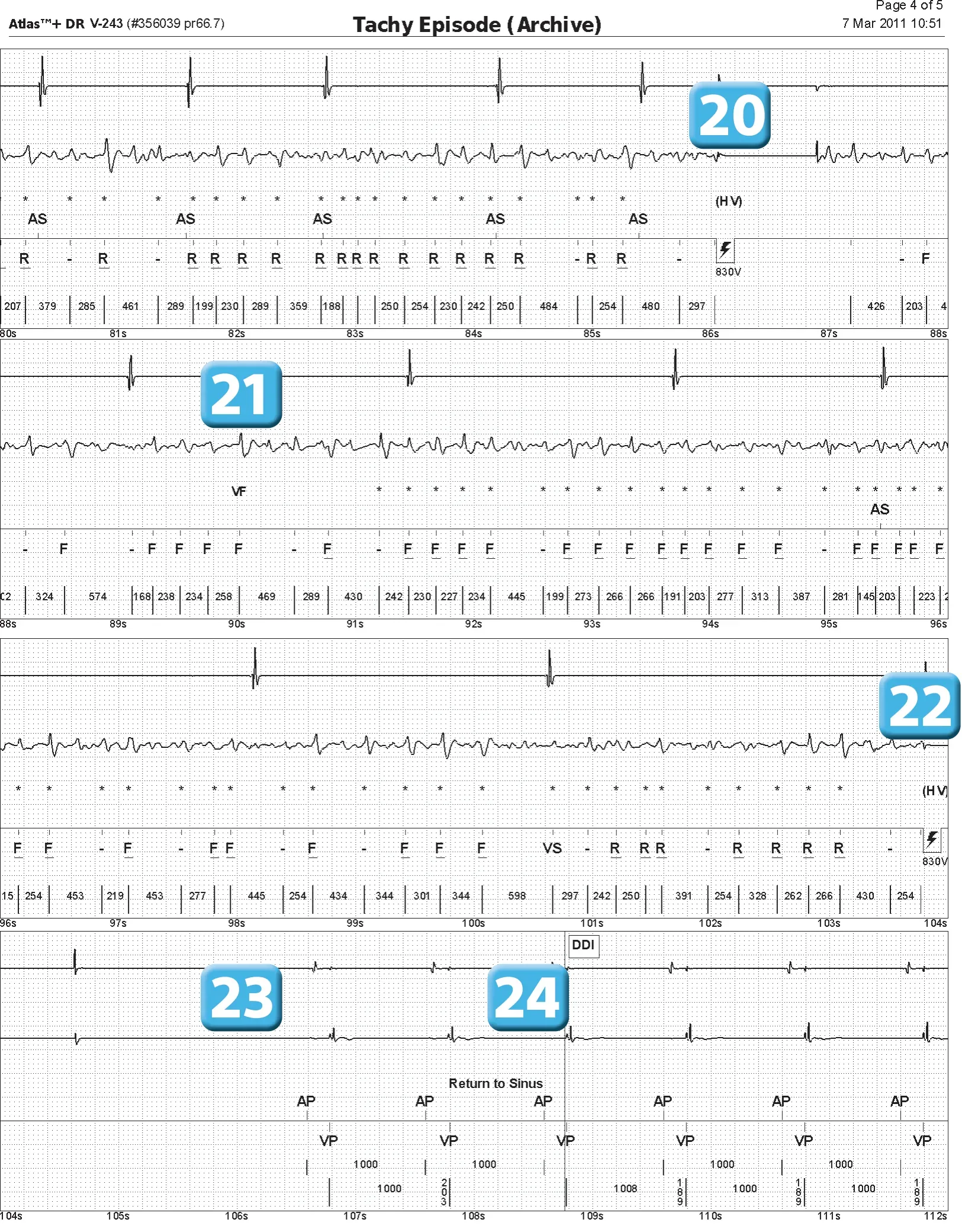 Abbott ICD electrogram, segment 4 of 4 — Episode of ventricular fibrillation and high defibrillation threshold