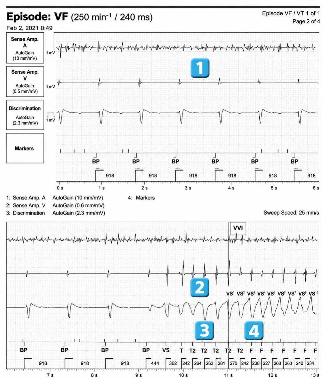 Abbott ICD electrogram, segment 1 of 3 — Lead dysfunction and DynamicTx™ algorithm