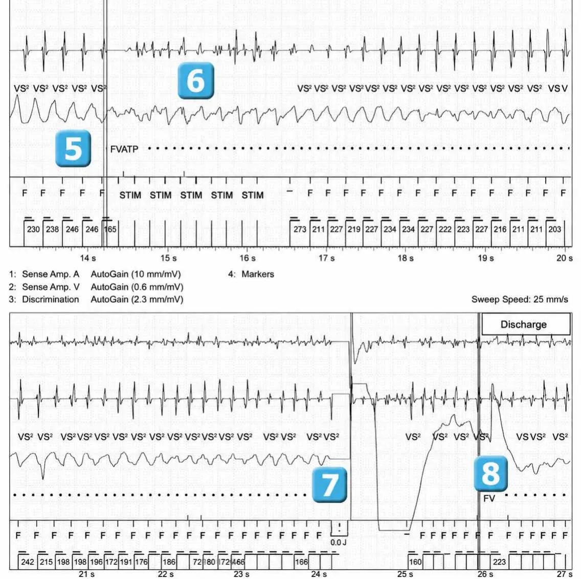 Abbott ICD electrogram, segment 2 of 3 — Lead dysfunction and DynamicTx™ algorithm