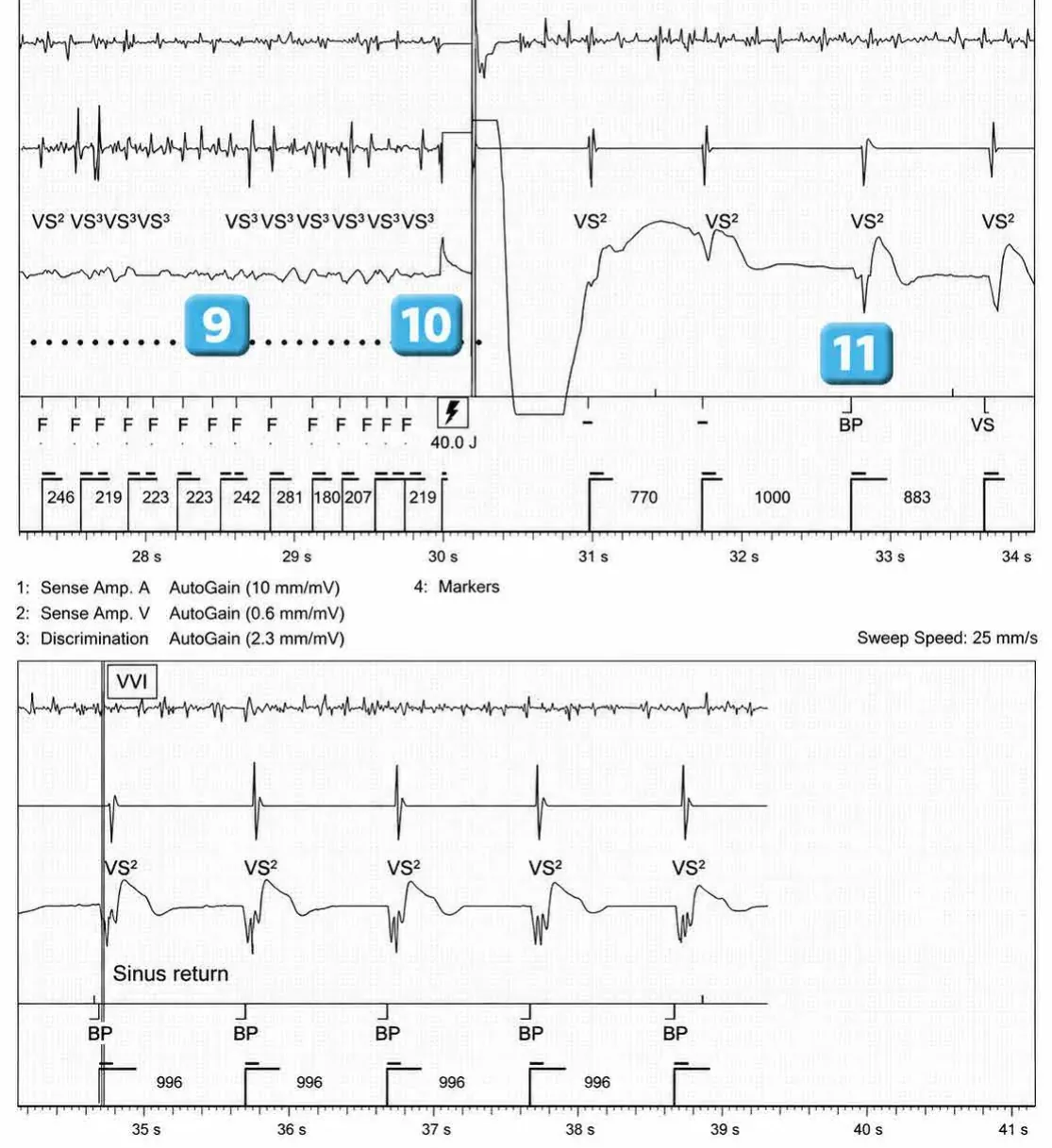 Abbott ICD electrogram, segment 3 of 3 — Lead dysfunction and DynamicTx™ algorithm