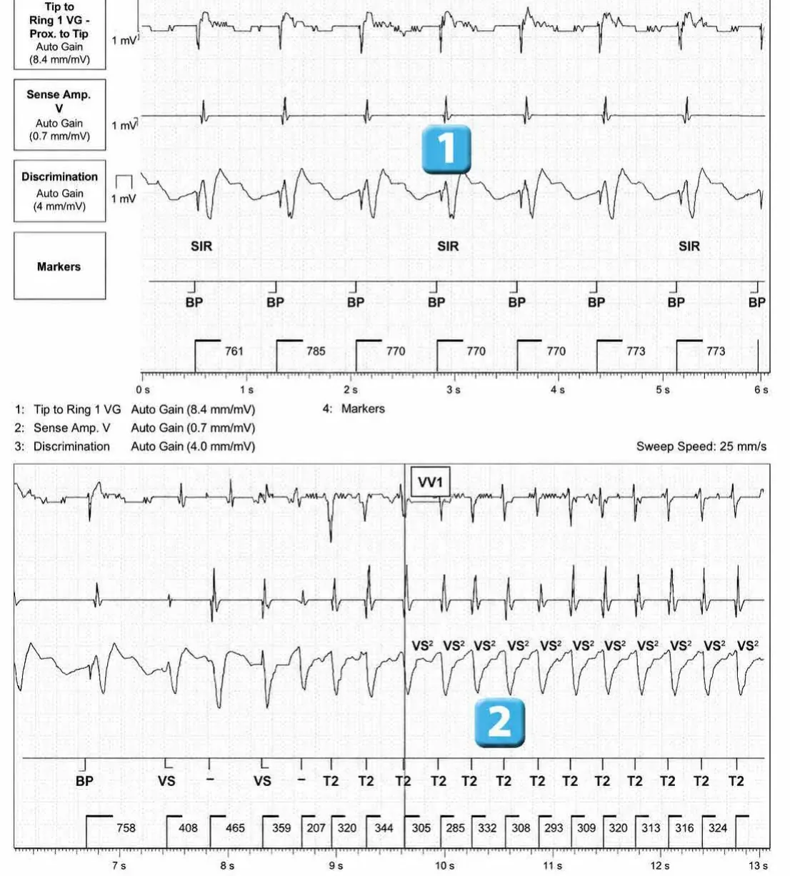 Abbott ICD electrogram, segment 1 of 4 — Activation of the VFTA algorithm to promote the delivery of an electric shock during an episode of ventricular arrhythmia