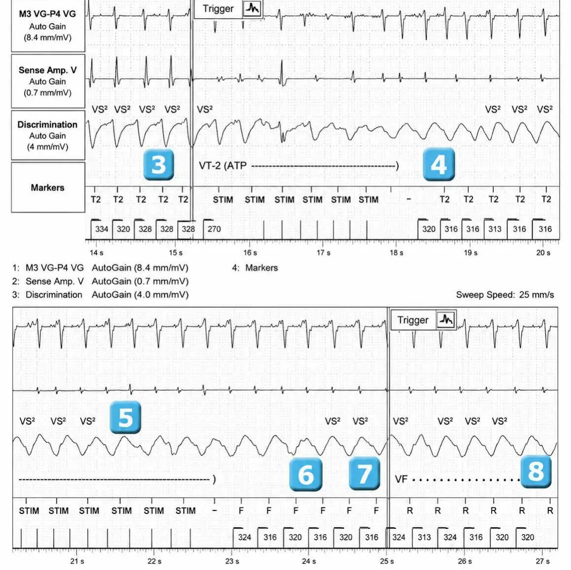 Abbott ICD electrogram, segment 2 of 4 — Activation of the VFTA algorithm to promote the delivery of an electric shock during an episode of ventricular arrhythmia