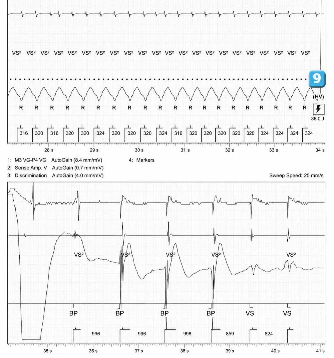 Abbott ICD electrogram, segment 3 of 4 — Activation of the VFTA algorithm to promote the delivery of an electric shock during an episode of ventricular arrhythmia