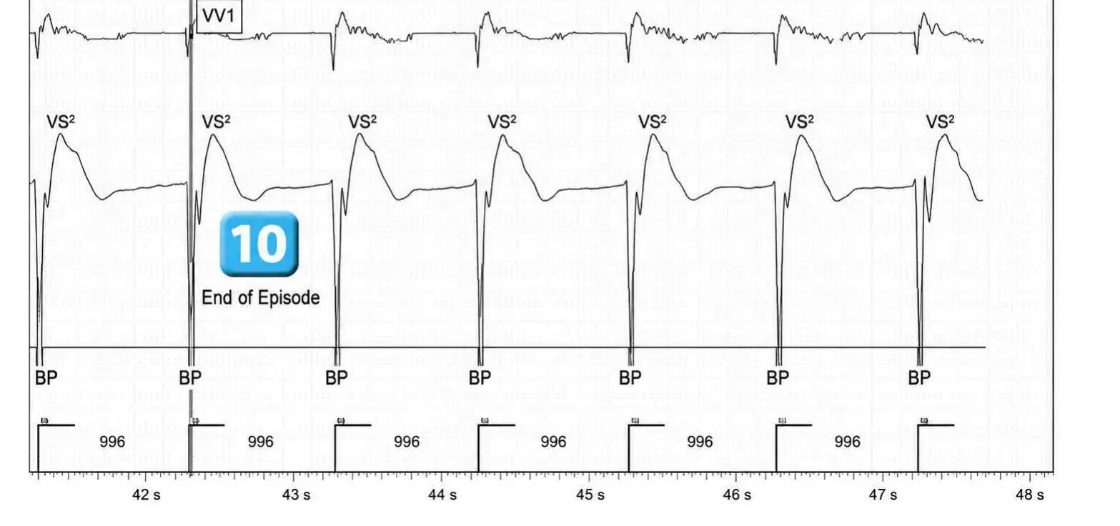 Abbott ICD electrogram, segment 4 of 4 — Activation of the VFTA algorithm to promote the delivery of an electric shock during an episode of ventricular arrhythmia