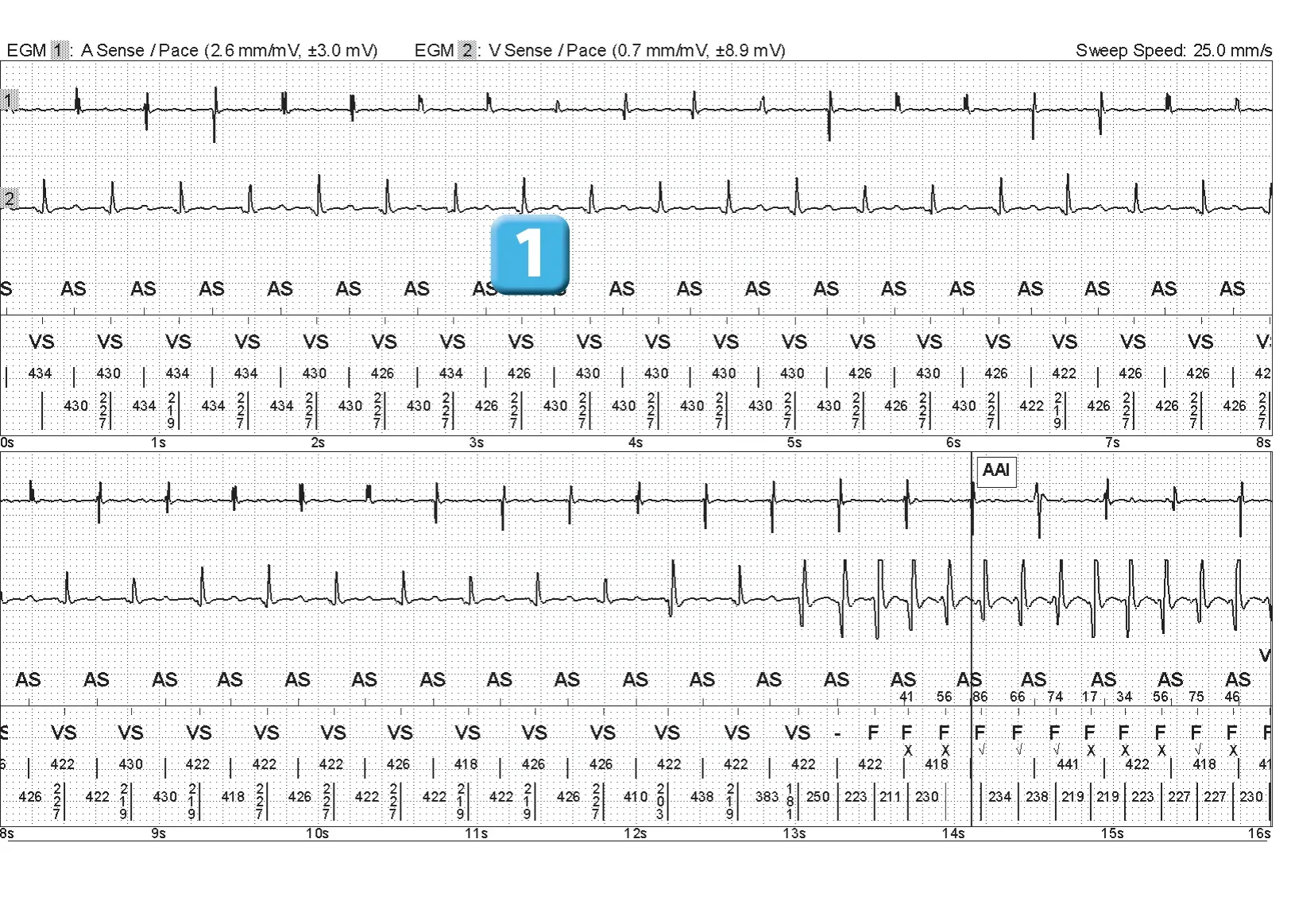Abbott ICD electrogram, segment 1 of 3 — Electrical shock and induction of an AF episode