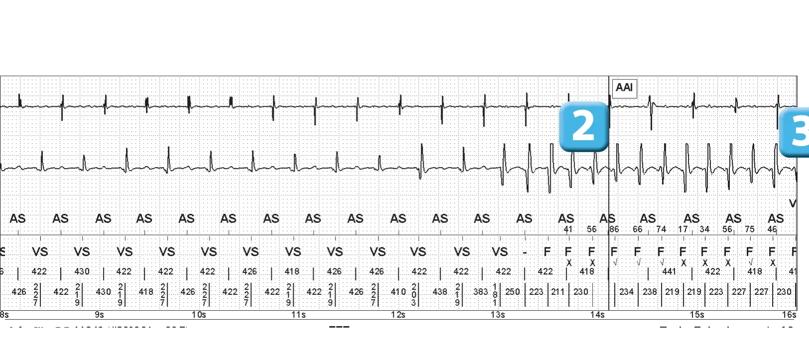 Abbott ICD electrogram, segment 2 of 3 — Electrical shock and induction of an AF episode